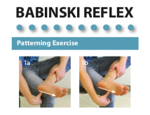 Babinski Reflex Exercise Handouts